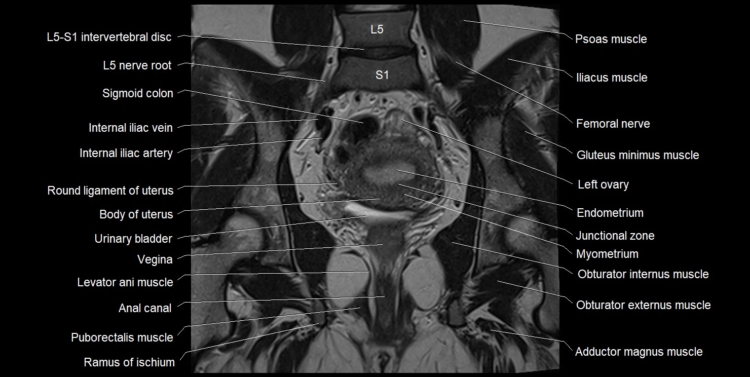 female pelvis coronal cross sectional anatomy image 20.webp
